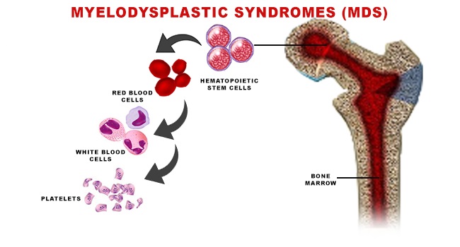 Hội chứng myelodysplastic